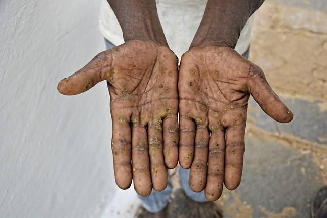 Arsenic keratosis caused due to long term exposure to water contaminated with arsenic (Image Source: Makarand Purohit)